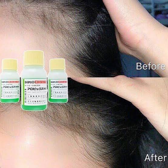Sato Arovics Solution 5% Carpronium chloride - 30mL (hair loss) šÆšµ Japan