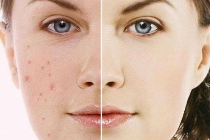 Lumos Acne Serum new 2025